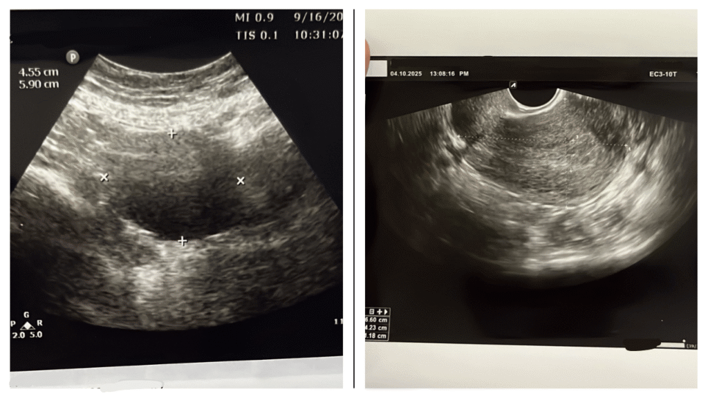 Before and after pelvic ultrasound scan showing an ovarian cyst on the left and clear healthy ovary on the right