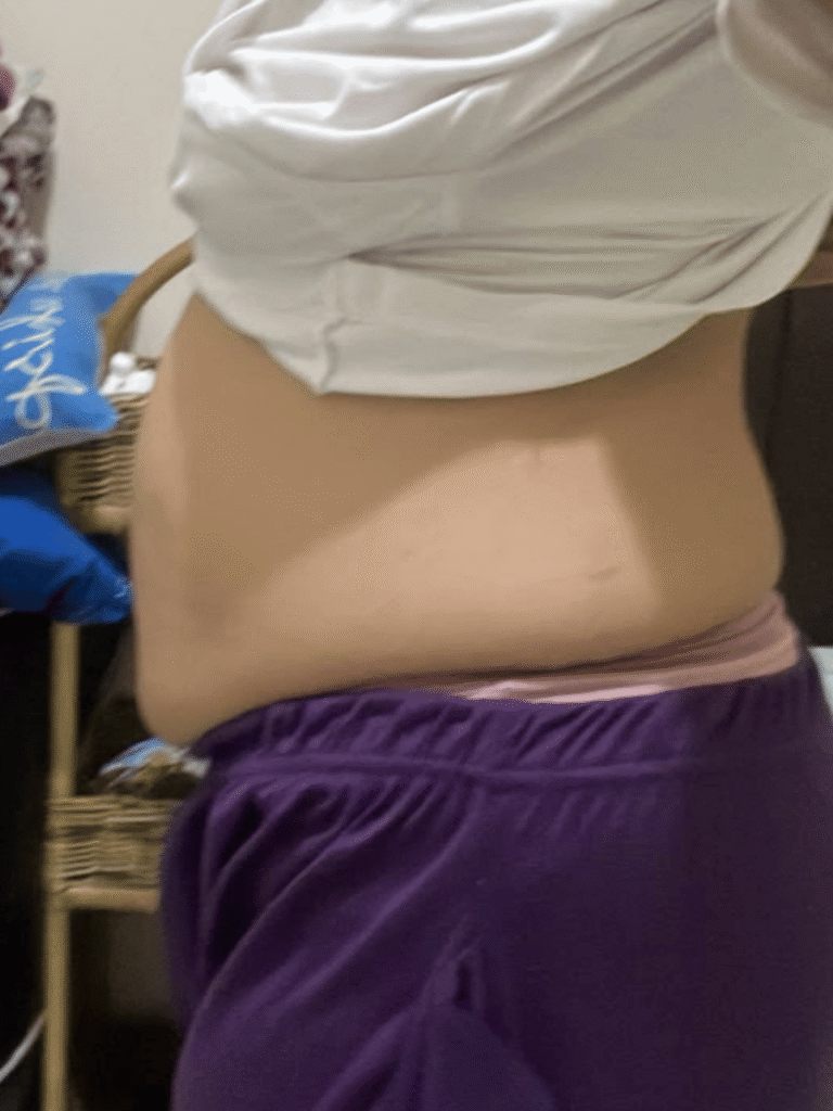 A photo showing severe stomach bloating